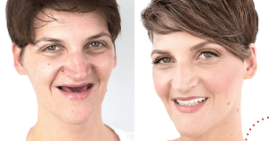 IMATE PROBLEMA SA ZUBIMA: Dolazak u Domovinu je vrijeme za odmor i rješavanje dentalnih problema mirela perkusic all on 4 (1)